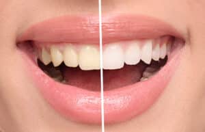 Zahnbleaching: Top-Produkte für das Zähne bleichen zu Hause