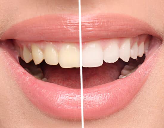 Zahnbleaching: Top-Produkte für das Zähne bleichen zu Hause