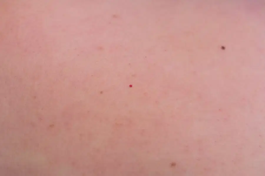 Kleine rote Punkte auf der Haut - was ist das?