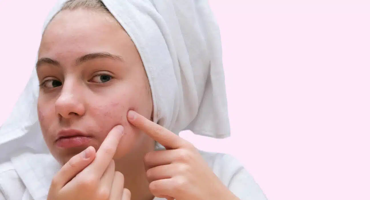 Warum sollte man keine Pickel ausdrücken?