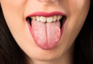 Wieso ist meine Zunge weiß?