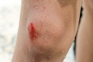 Schürfwunde am Knie.