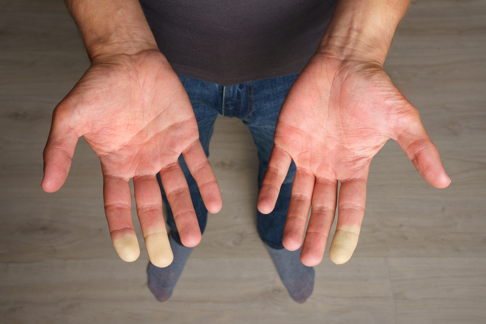 Gefrorene Hände im Winter mit plötzlich auftretenden Verfärbungen können auf das Raynaud-Syndrom hinweisen