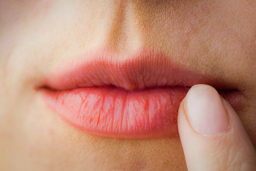 Frau zeigt mit dem Zeigefinger auf ihre leicht irritierten Lippen als Symbolbild für den Ratgeber: Entzündete Lippen roter Rand