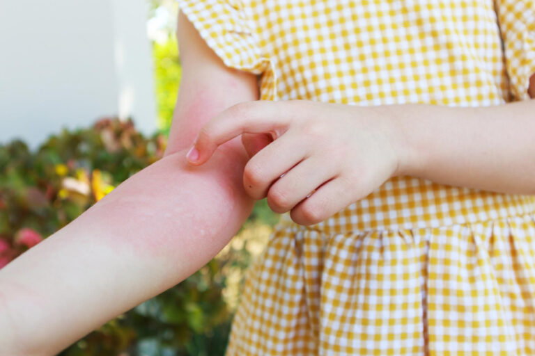 Kind kratzt sich am geröteten Unterarm mit Sonnenbrand, trägt gelbes Sommerkleid mit Karomuster.